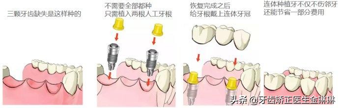 种植牙不用切牙龈做法,种牙不用缝线吗