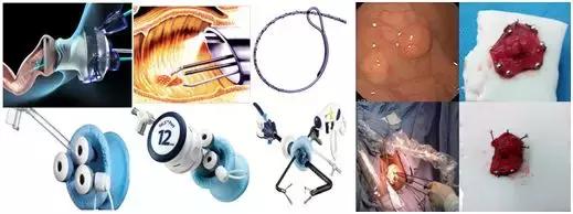 直肠神经内分泌肿瘤分级和治疗,直肠神经内分泌肿瘤到底是不是癌