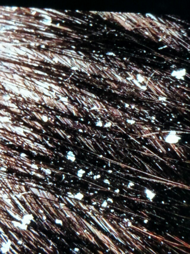 鹤叔头皮屑治疗方法,鹤叔治头皮屑的视频