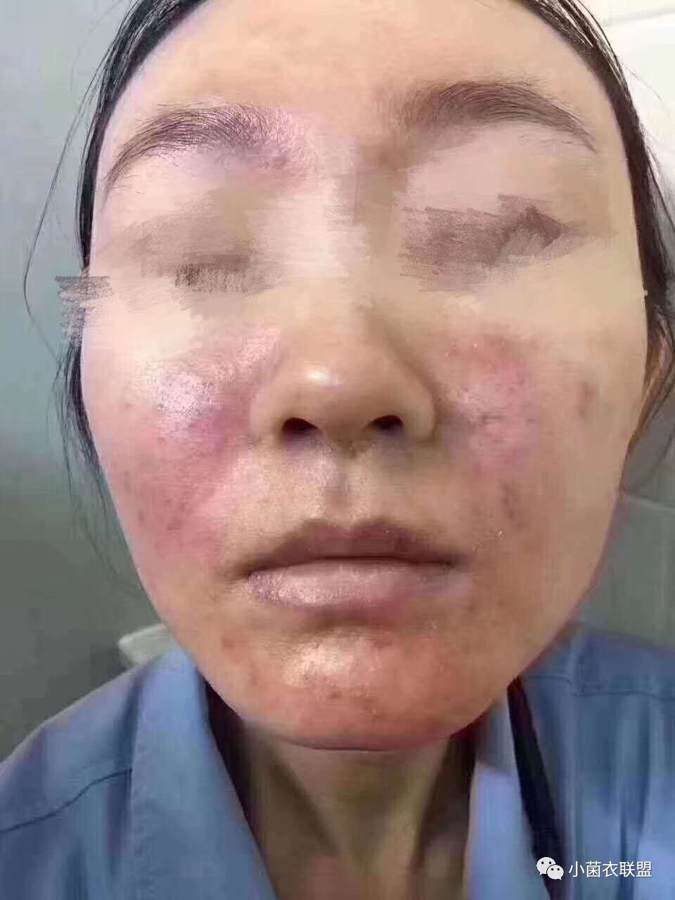 面部红血丝丘疹,白眼圈透红是什么原因