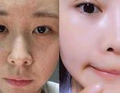 面膜最近最火,医美面膜的成功之路