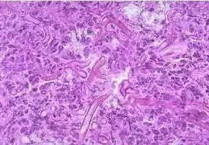 尴尬!用避孕套竟患霉菌性阴道炎