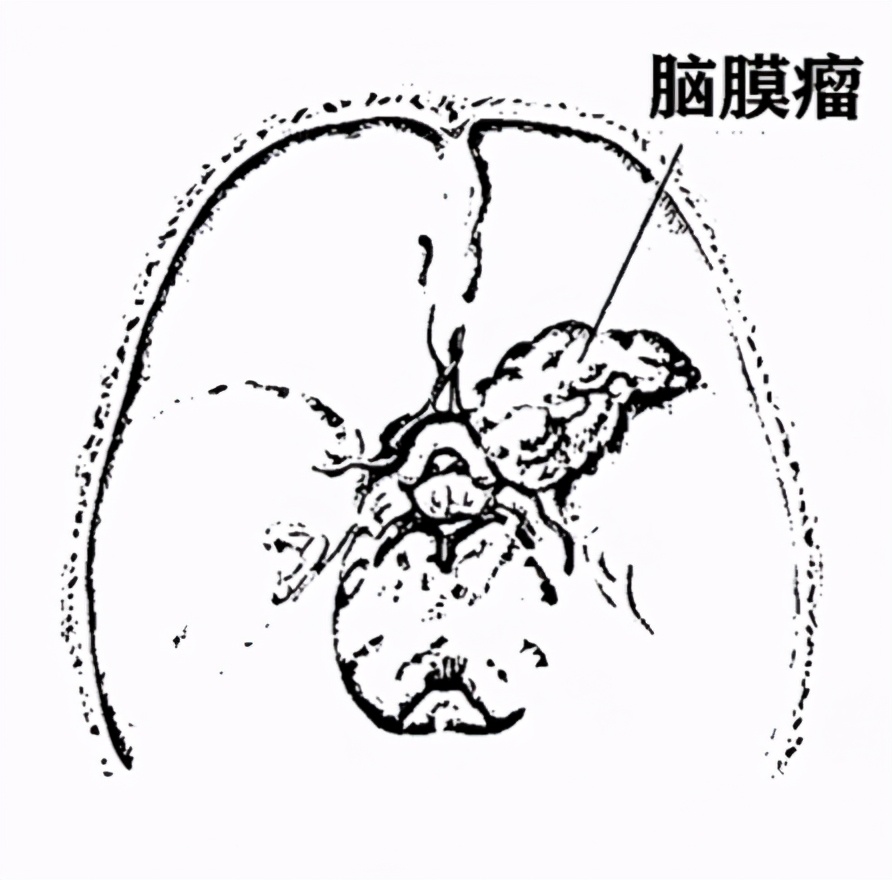 脑膜瘤术后一年后复发怎么办,脑膜瘤复发后不能手术该怎样治疗