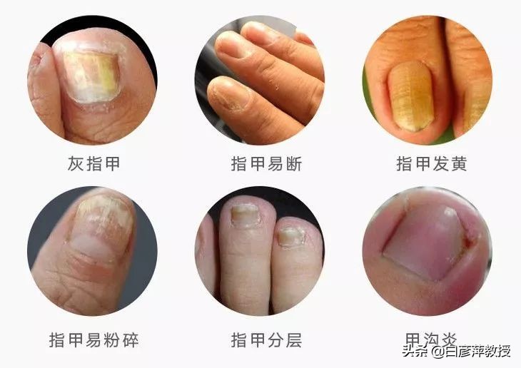 灰指甲是灰色的吗？灰指甲真的会传染吗？皮肤科医生告诉你