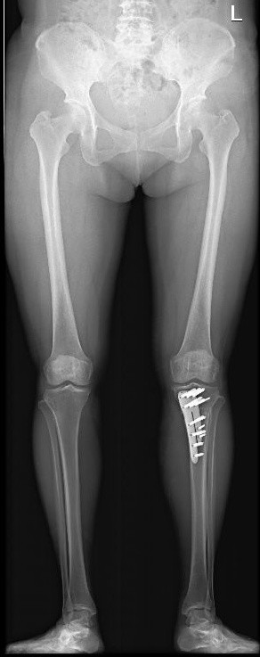 膝关节阶梯治疗ppt,膝关节骨性关节炎阶梯化治疗
