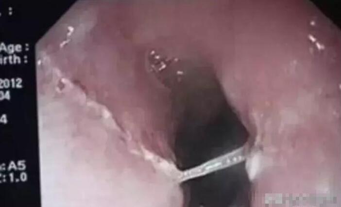 孩子被鱼刺卡住了在家如何解决,小孩被鱼刺卡不配合怎么办