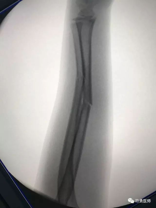 孩子骨折了一定要做打钢针手术吗,儿童摔伤骨折需要手术么