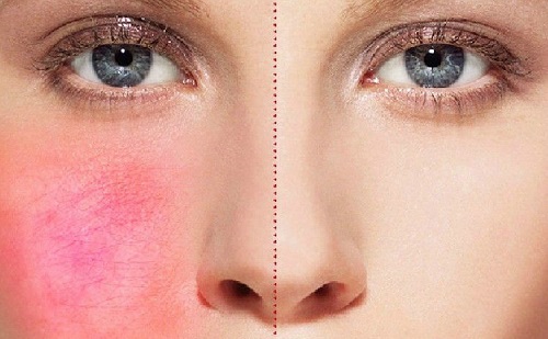 血丝斑点如何祛除,红血丝该怎么处理