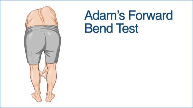 脊柱侧弯平躺下来症状消失,婴幼儿脊柱侧弯有什么症状