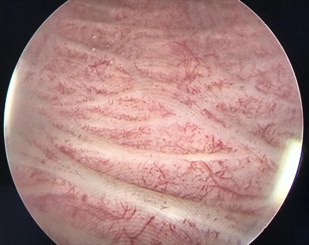 一小时解除多年顽疾，老人家再也不用四处找厕所