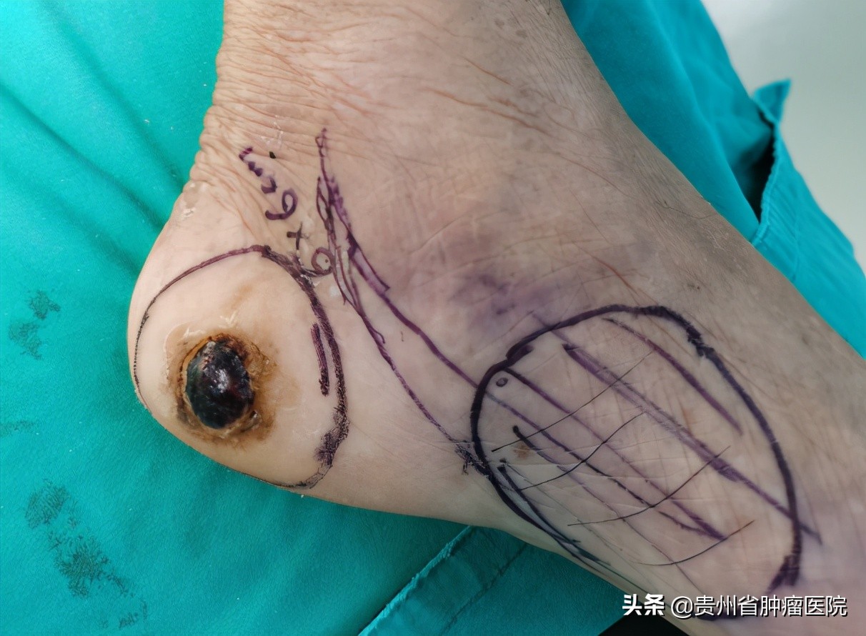 眼睛黑色素瘤的特征,眼睛黑色素瘤的早期症状