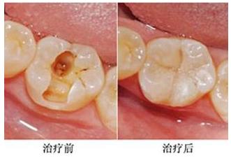 再小的龋洞也不能拖,拖下去就是一个“无底洞”
