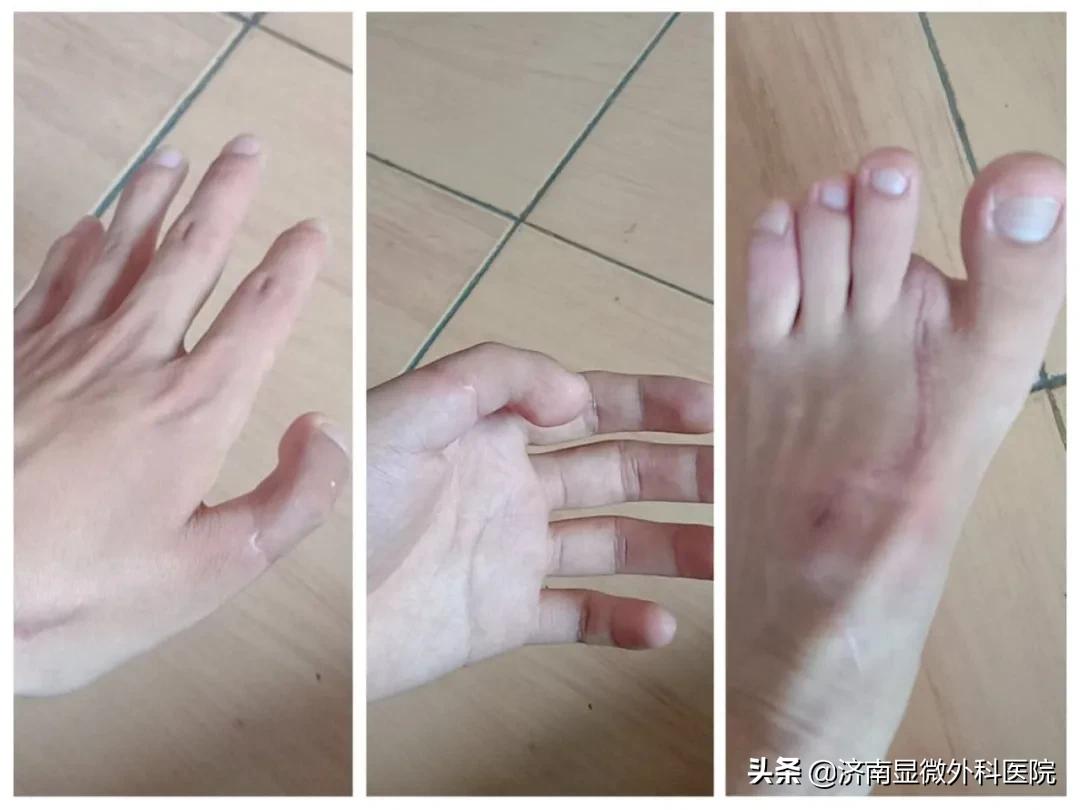 手指少了一块肉怎么处理,手指少了一截