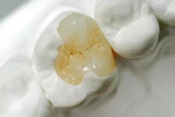 口碑好的补牙齿到底怎么样,补牙材料不对劲