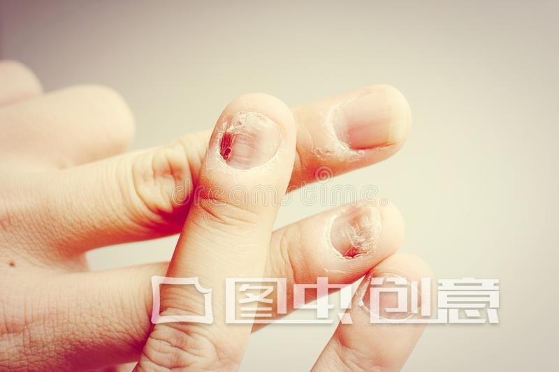 小朋友咬指甲抠指甲的危害,孩子咬手指甲抠指甲是什么原因