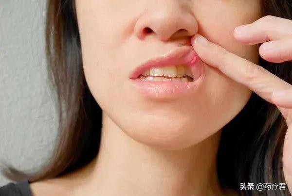 还在为口腔溃疡而烦恼？这里教你几个小妙招，快速止痛