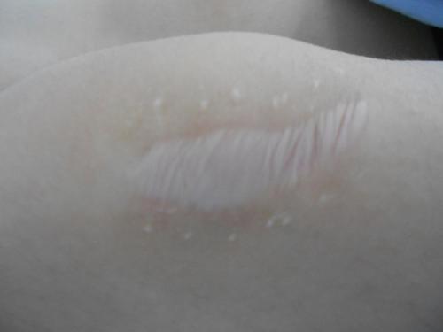 疤痕性白斑是白癜风吗,继发性白癜风和白癜风有什么区别