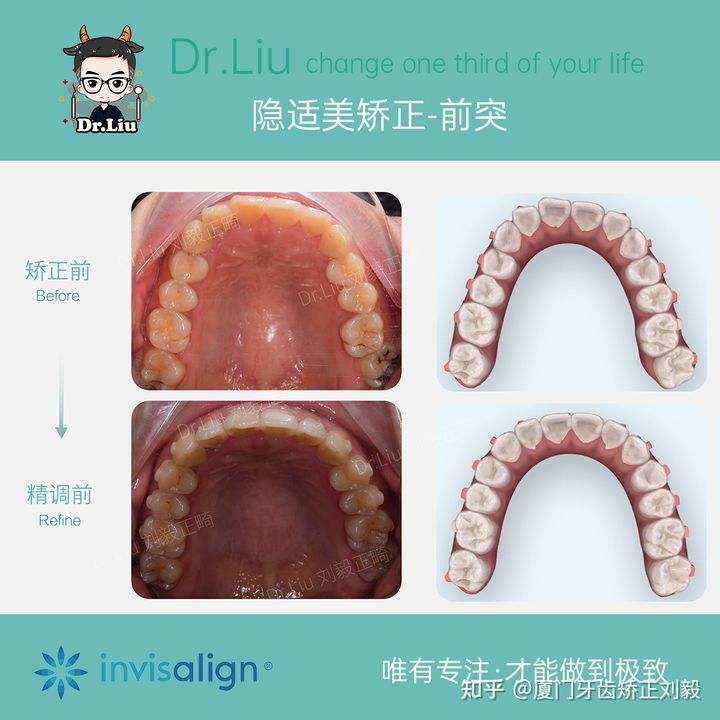 正畸临床拔牙矫治,拔牙正畸矫正嘴凸案例