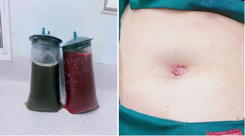 卵巢肿瘤新技术,卵巢恶性巨大肿瘤手术