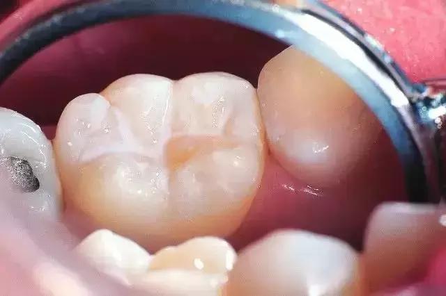 做父母的要懂得管教,窝沟封闭值得做吗