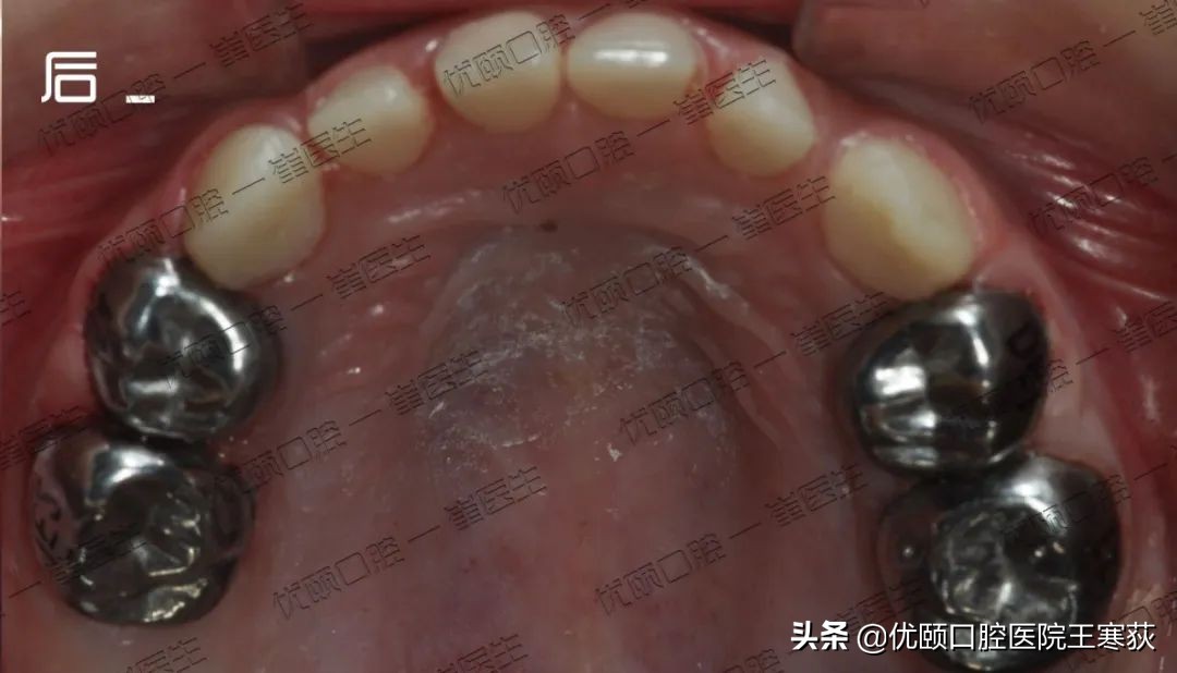 儿童全麻治疗过程,三岁宝宝根管治疗全麻有危害吗