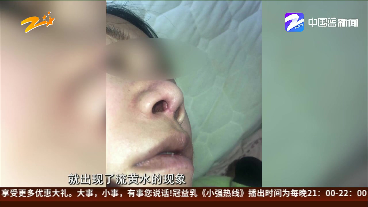 女子隆鼻手术出血,女性做鼻综合手术后的心态