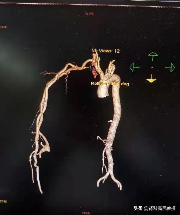 尿毒症手臂造瘘,乳腺癌十年胳膊肿了会有危险吗