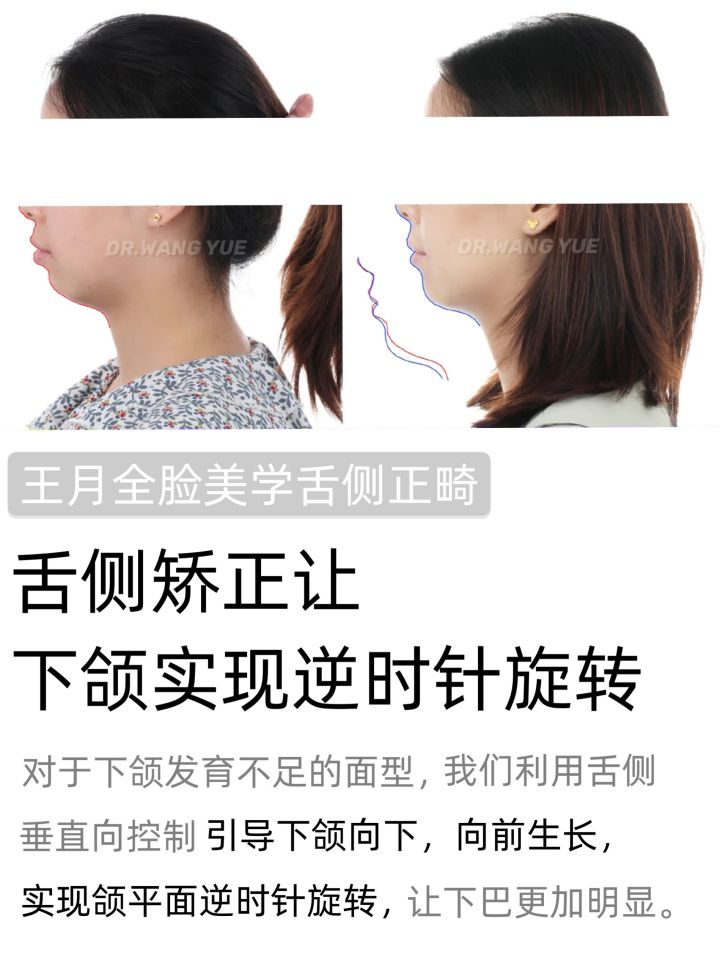 上海舌侧正畸医生,上海舌侧矫正哪家好