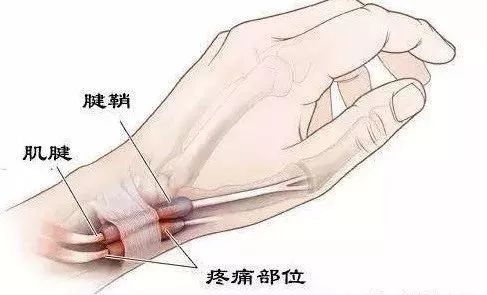 什么是打封闭治疗,什么是封闭注射