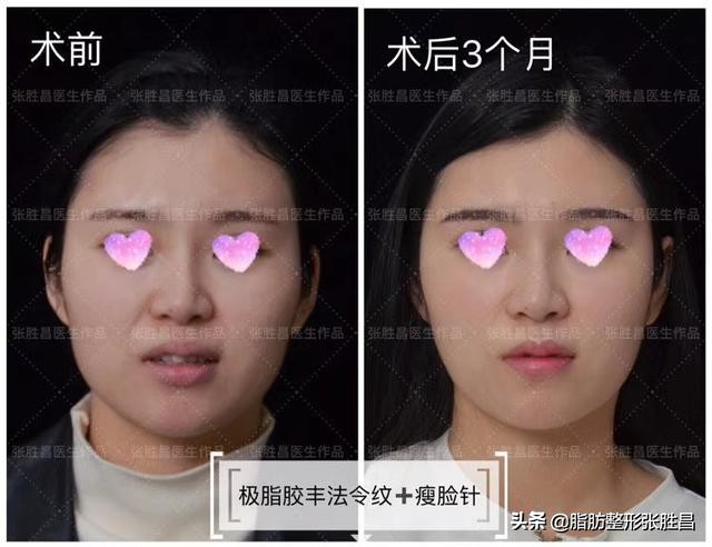 为什么我笑起来有皱纹,为什么我笑起来很显老