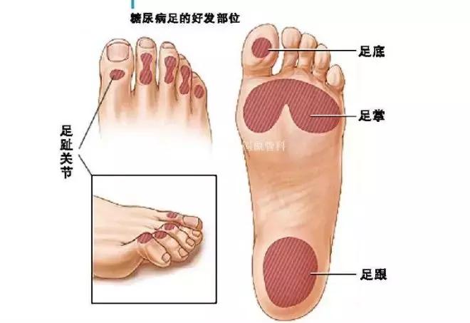 糖尿病人如何选购适合的鞋子,糖尿病患者如何选择鞋