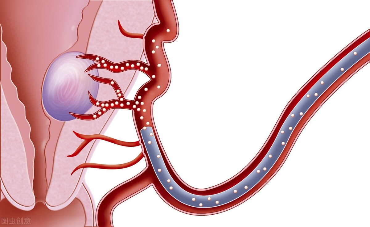 子宫腺肌症专家共识2020,子宫腺肌症诊疗指南