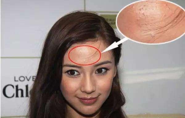 闭合性粉刺如何彻底根治,闭合性粉刺怎么才能根除