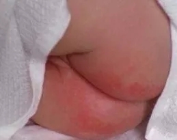 新生儿红屁股最好的办法,新生儿红屁股怎么办最有效
