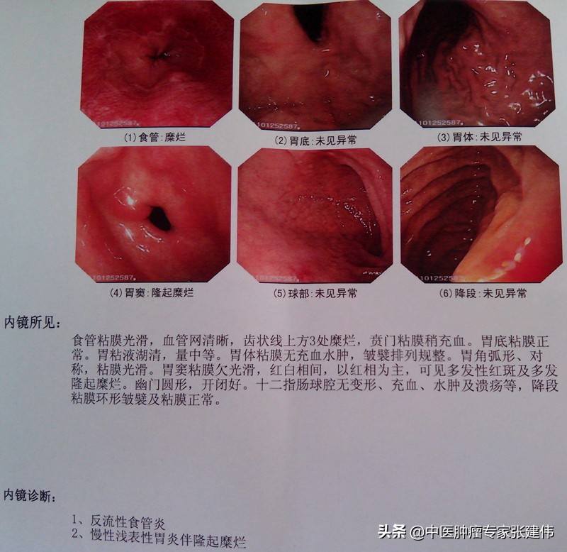 胃镜怎么看整个胃的情况,怎么知道做完胃镜对胃的损伤