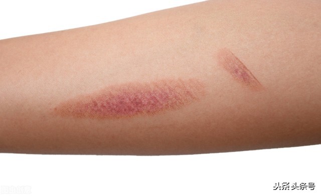 烫伤好了有红色凸起是疤痕增生吗,祛烫伤疤痕增生最简单的方法