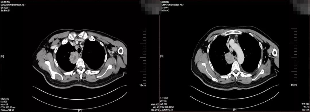 肺癌晚期可以靶向加免疫治疗吗,肺癌晚期化疗加免疫治疗有效吗