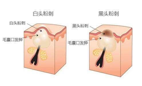 身上的螨虫会粘在衣服上吗,身上螨虫太多身体会烂么