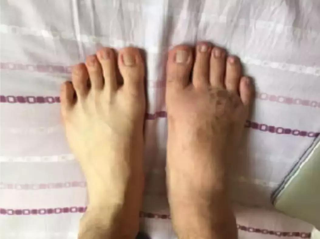 中国留学生被截肢,励志留学生