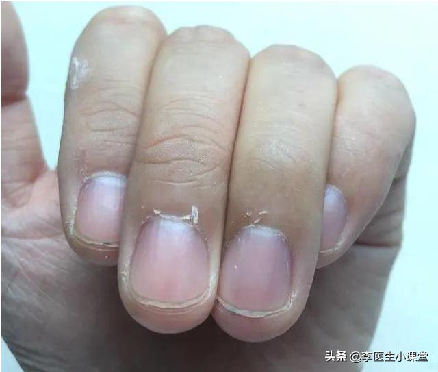 口腔溃疡起粉刺是缺维生素吗,口腔溃疡呈菜花状是什么病