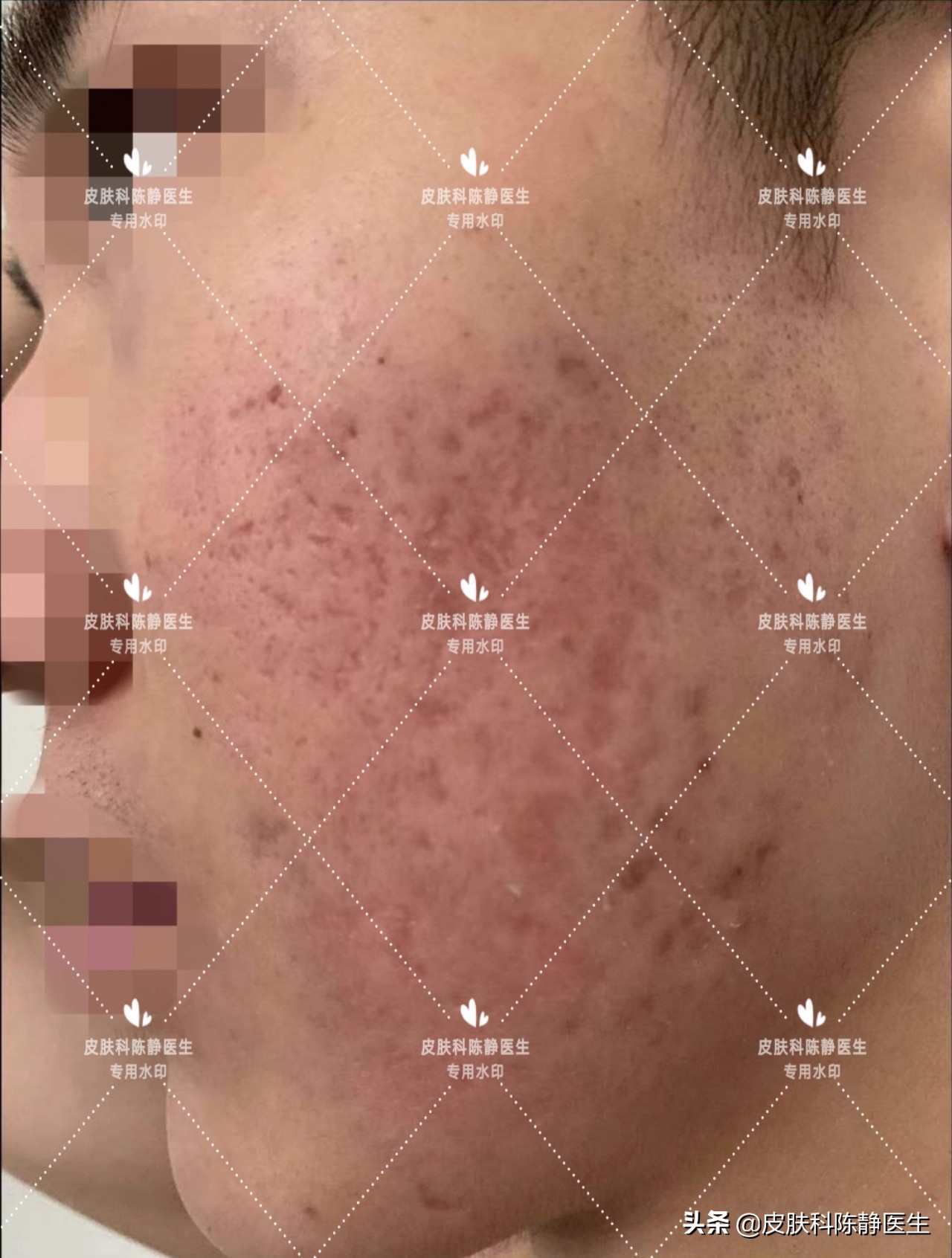 治疗脸部痤疮中医好还是西医好,传统治疗痤疮