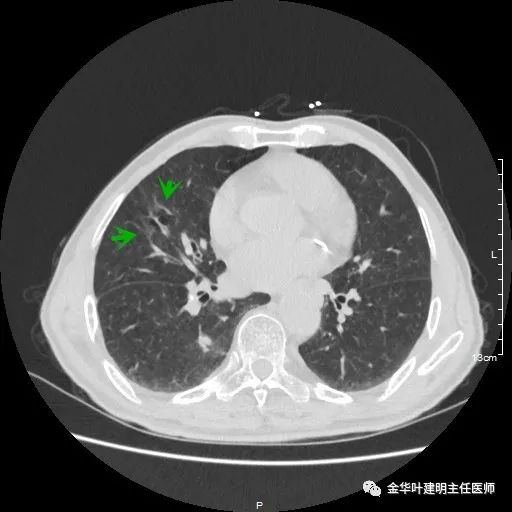 多发原发肺癌能根治吗,肺部原发性恶性肿瘤好治