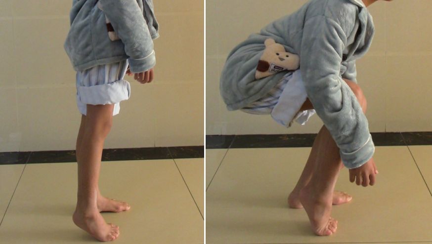 踮脚走路能改善足内翻吗,经常踮脚会伤膝关节吗