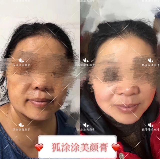 祛痘印痘坑用什么产品最好,什么产品祛痘印和祛痘最好最快