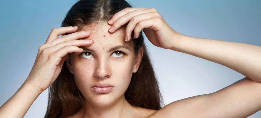 脸上长白色米粒痘痘怎么快速消除,脸上痘痘里面白色米粒是什么东西