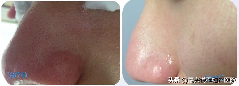 果酸是什么美容项目,能量果酸和果酸有什么区别