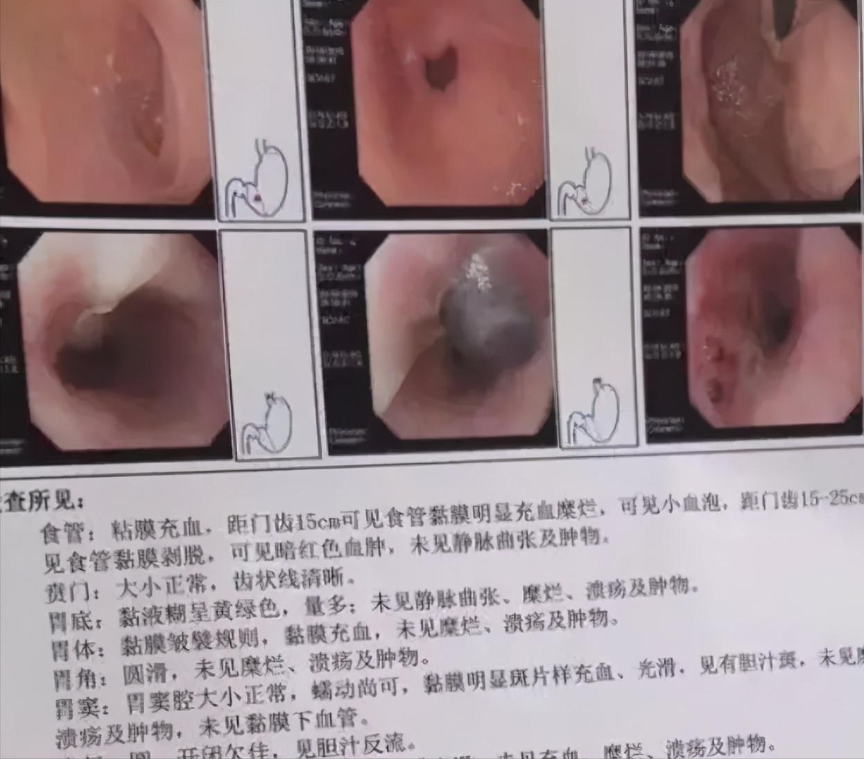 50cm“仙女管”插入少女胃里,这种自虐工具竟在淘宝卖疯了