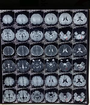 头晕耳鸣听力下降,头晕脑胀听力下降怎么回事