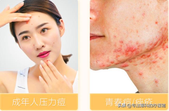 片仔癀的祛痘产品怎么样,片仔癀祛痘贴评价