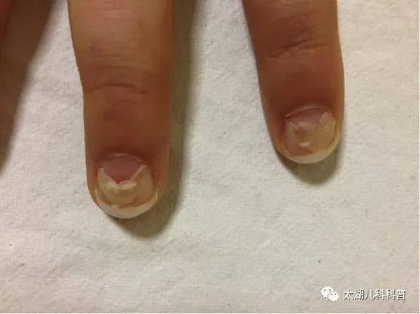 小孩子指甲从根部脱落是怎么回事,孩子手足口病后指甲脱落怎么回事